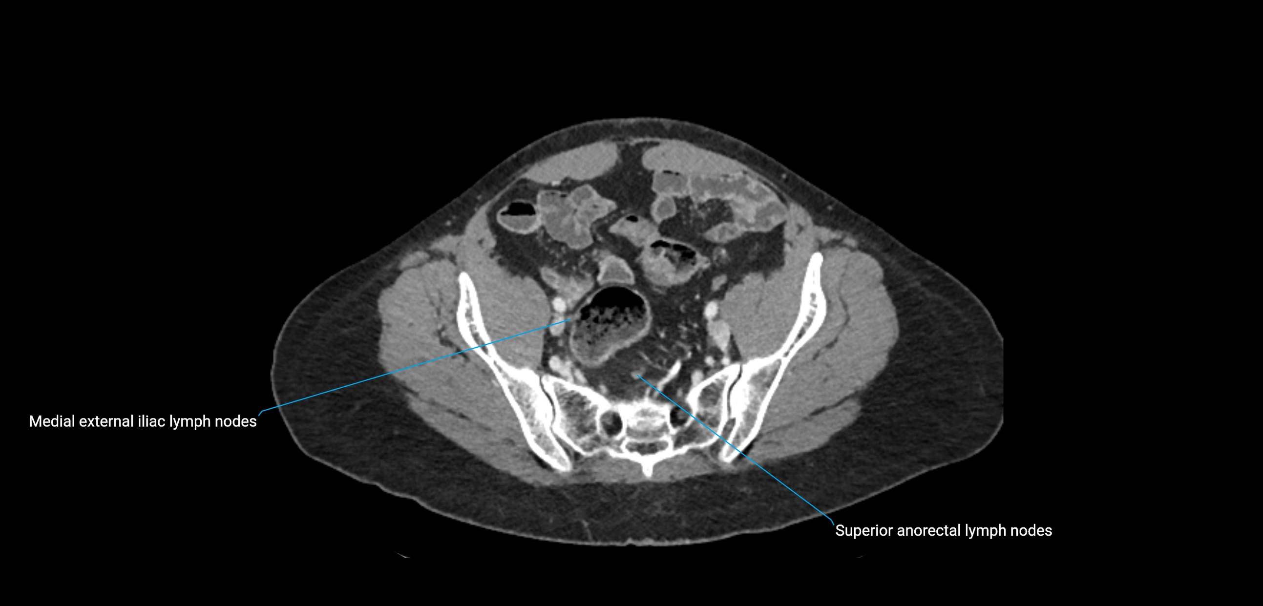 CT ct abdominal lymph nodes  axial cross sectional anatomy  enchanced radiology image -img-00002-00336.webp